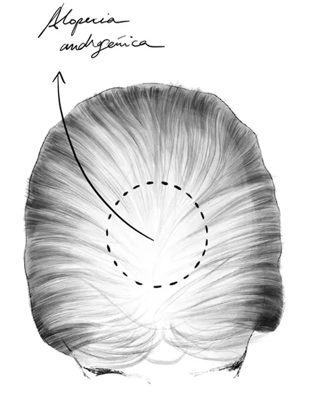 Alopecia Androgênica Feminina