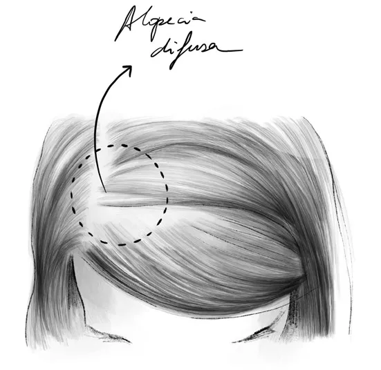 Alopecia difusa