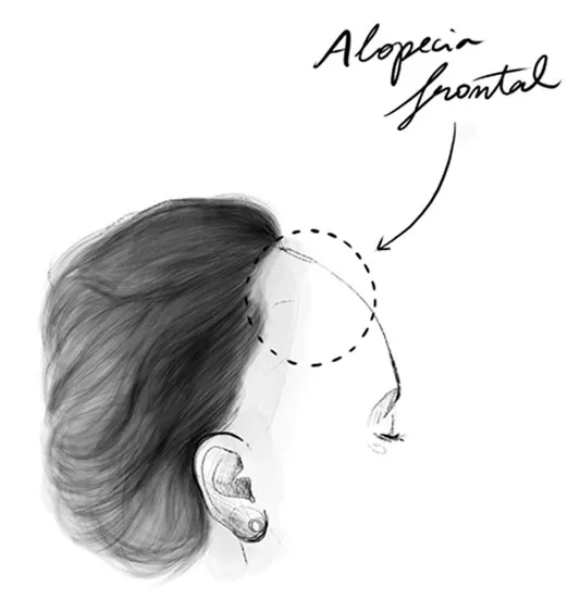 Alopecia fibrosante frontal